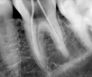 root canal treatment