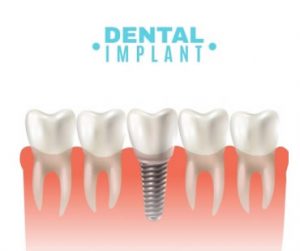 Dental implant