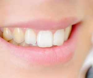 teeth whitening