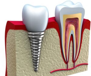 dental implants dentist in Clinton NJ