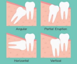 Wisdom teeth dentist