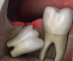 Wisdom teeth dentist in Clinton NJ