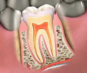 Root canal treatment Clinton NJ