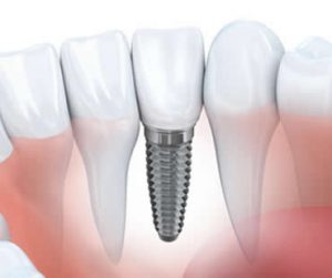 Dental Implants