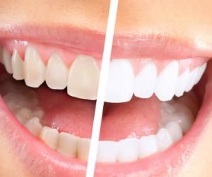 teeth whitening dentist