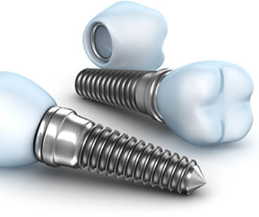 Implant dentist in Clinton NJ