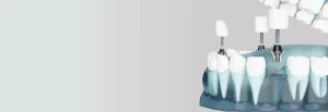 computer guided dental implant