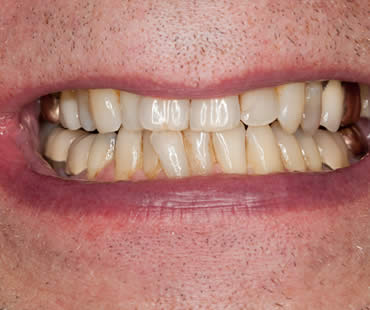 Tips for Preventing Plaque Buildup