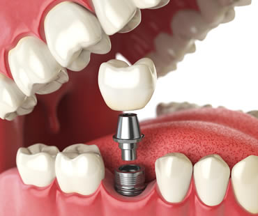 Restore Your Smile with Dental Implants