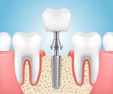Dental Implants: The Leading Option for Tooth Restoration