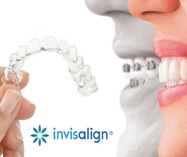 Invisalign vs. Traditional Metal Braces