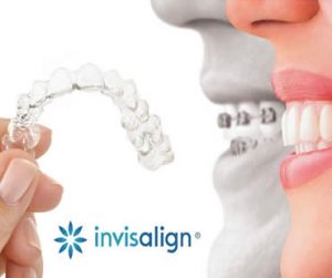 Invislaign in Clinton NJ