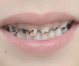 Cavities Not Just for Kids