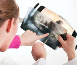 root canal treatment